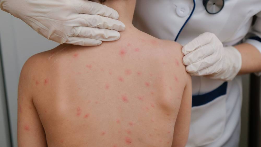 Santa Cruz adelanta el descanso pedagógico por brote de sarampión