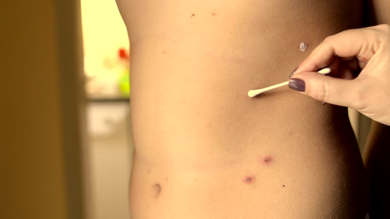 Santa Cruz ya reporta 20 casos de sarampión